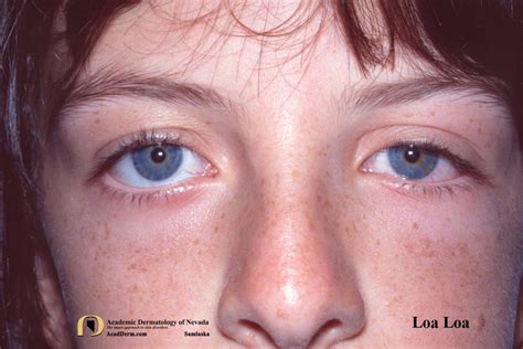 Loiasis: Loa Loa, Tropical Swelling... - Academic Dermatology of Nevada