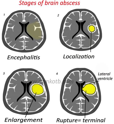 Brain abscess stages Home | Neurosurgery Neurocirugía Neurociencia ...