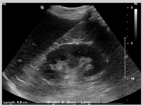 Right kidney in long-axis, after drainage of perinephric abscess ...