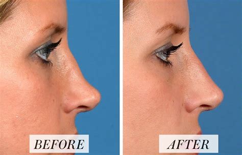 Liquid rhinoplasty, aka the nonsurgical nose job, is a quick, virtually ...