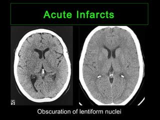 CT Imaging of Cerebral Ischemia and Infarction | PPT