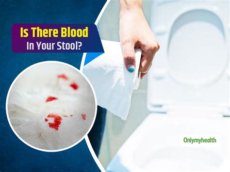 How To Check For Blood In Stool - Memberfeeling16