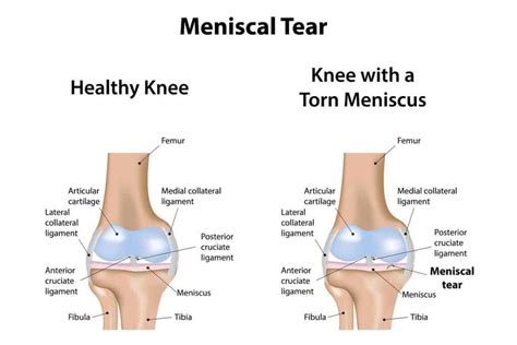 Causes and Diagnosis of a Meniscal Tear | Blackberry Clinic Blog