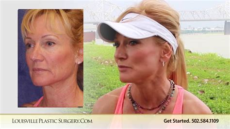 Mini Facelift Tawnia Recovery Timeline - YouTube