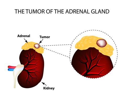 Adrenal Gland Tumor Ultrasound