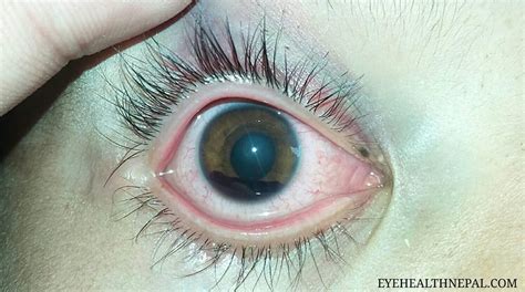 What is Hyphema? How to Treat Hyphema and its Complications - Eye ...