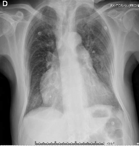 Chest radiograph. Signs of hyperinflation, lung parenchymal scarring ...