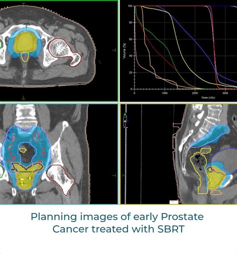 Stereotactic Body Radiation Therapy (SBRT) – Dr. Saurabha Kumar