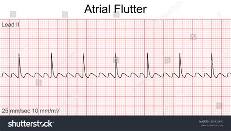 Atrial Flutter Vs Atrial Fibrillation