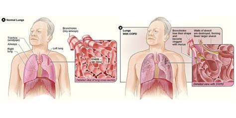 Capno 101: What is COPD? - CapnoAcademy CapnoAcademy