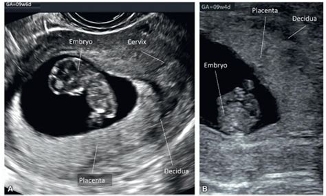 Placenta and Umbilical Cord | Radiology Key