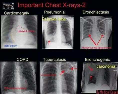 Mejores 47 imágenes de RADIOGRAFÍA DE TÓRAX en Pinterest | Salud, La ...