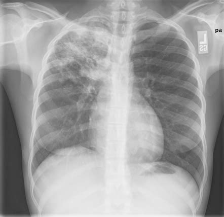 Tuberculosis Vs Pneumonia X Ray