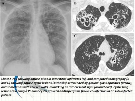 Cystic Lung Diseases