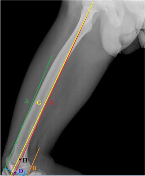 Sagittal mechanical ratio: A novel technique to define sagittal ...