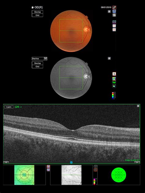 What is an OCT Scan? - Dipple & Conway