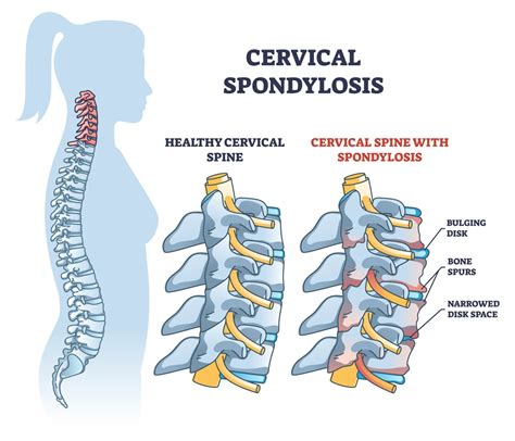 Top 7 Best Exercises For Cervical Spondylosis To Reduce Pain