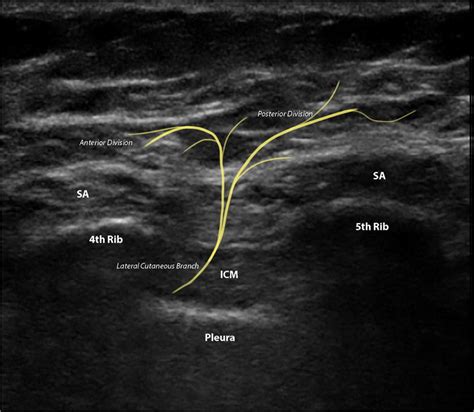 USG anatomy for the serratus anterior plane block. SA serratus ...