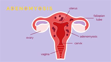 Adenomyosis: New 3 Symptoms, Causes And Risk Factors