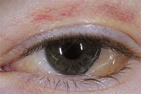 Swelling (chemosis) of the conjunctiva - Stock Image C011/7531 ...