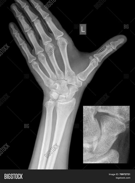 Hand Wrist X-ray, Scaphoid Fracture Image & Photo | Bigstock