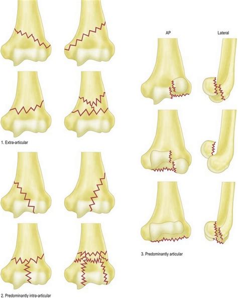 The Management Options for Adult Distal Humeral Fractures ...