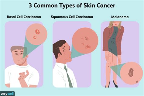 Types Of Skin Cancer Treatment