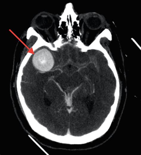 Cureus | Follow-Up by Transcranial Doppler After Rupture of a Giant ...