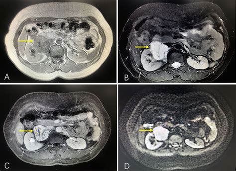 Frontiers | Case report: Capillary hemangioma in the renal hilum ...