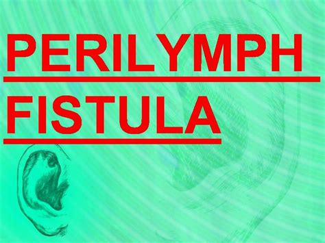 المدونة الطبية د.فهيد سالم السبيعي: PERILYMPH FISTULA