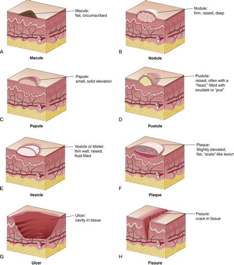 Vascular Skin Lesions Chart