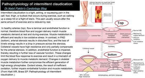 Intermittent Claudication - Pictures, posters, news and videos on your ...