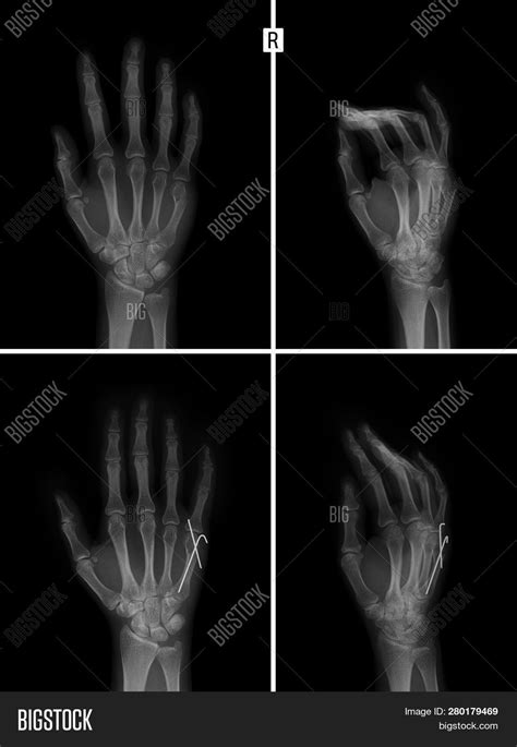 X-ray Hand. Fracture Image & Photo (Free Trial) | Bigstock