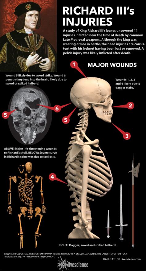 The Fatal Wounds of King Richard III (Infographic) | Live Science