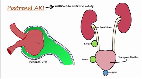 Acute Kidney Injury (AKI) - Prerenal,Intrarenal,Postrenal - YouTube