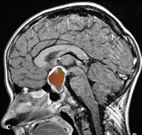 Craniopharyngioma - UF Health