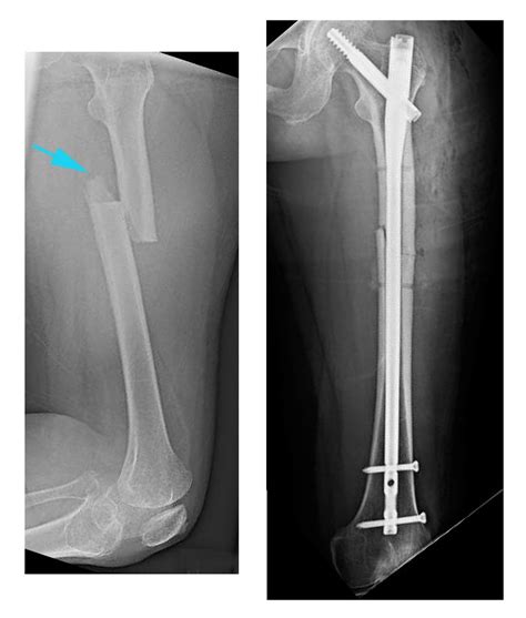 Broken Femur X Ray