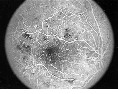 What Is Fluorescein Angiography? - American Academy of Ophthalmology