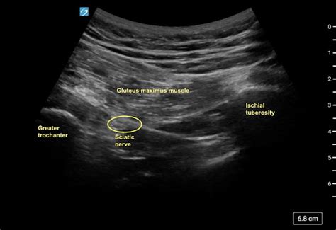 Ultrasound Guided Transgluteal Sciatic Nerve Block for Refractory ...