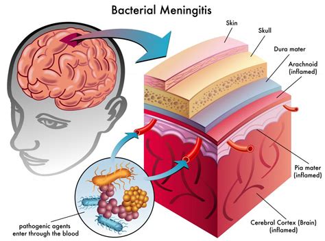 What are the Meninges? (with pictures)