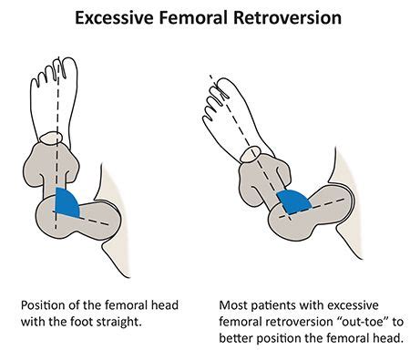 Anteversion at the hip - Google Search | WCCMT | Pinterest | The o'jays ...