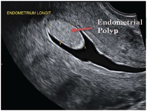 Endometrial polyps: Pathogenesis, sequelae and treatment - Njume Peter ...