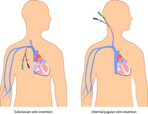 Study Medical Photos: Central venous Line/ Catheter Related Infections ...