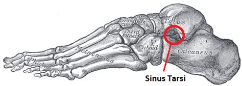 Sinus Tarsi Syndrome - Back in Action