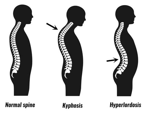 Scheuermann's Disease - Symptoms, Causes & Treatment