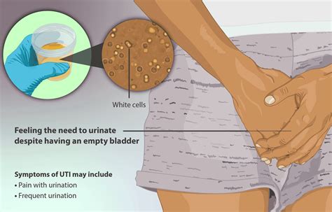 How to recognise and Treat UTIs - DAME