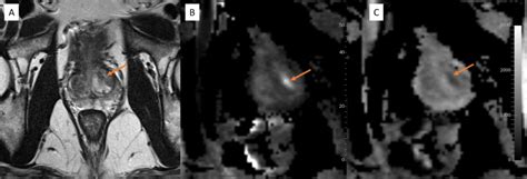 [Figure, MRI Prostate: PIRADS-3; A: Axial...] - StatPearls - NCBI Bookshelf