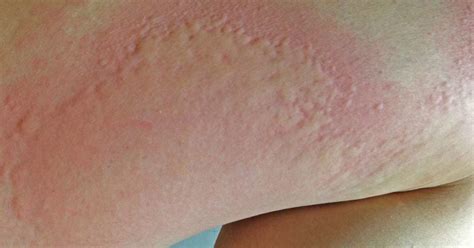 Hepatitis Skin Rash Pictures