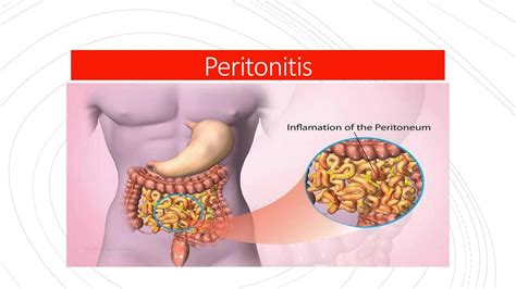 Peritonitis | Sabru Belen | uDocz