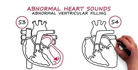 Introducing Third & Fourth Heart Sounds – Platform | CME